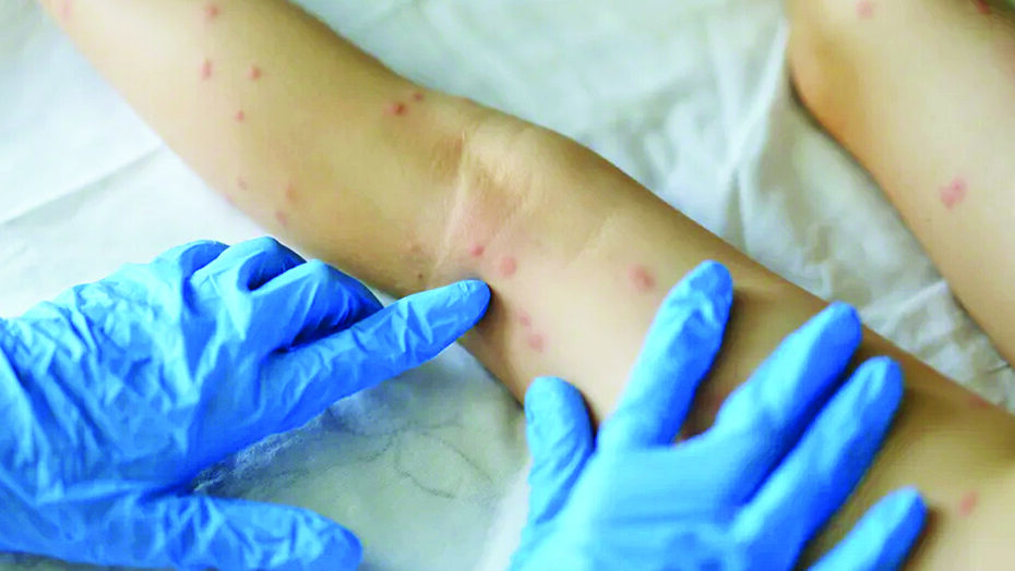 Sintoma mais característico da varíola dos macacos é a formação de erupções e nódulos dolorosos na pele - Foto: Getty Images